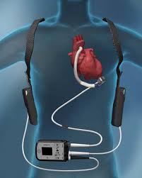 Mechanical heart support with a left ventricular assist device (LVAD)